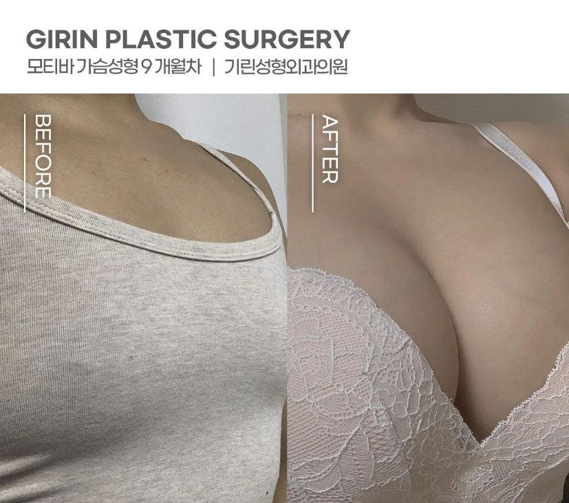 가슴성형외과유명한곳 확실하게 알아보고 관련 이미지 4