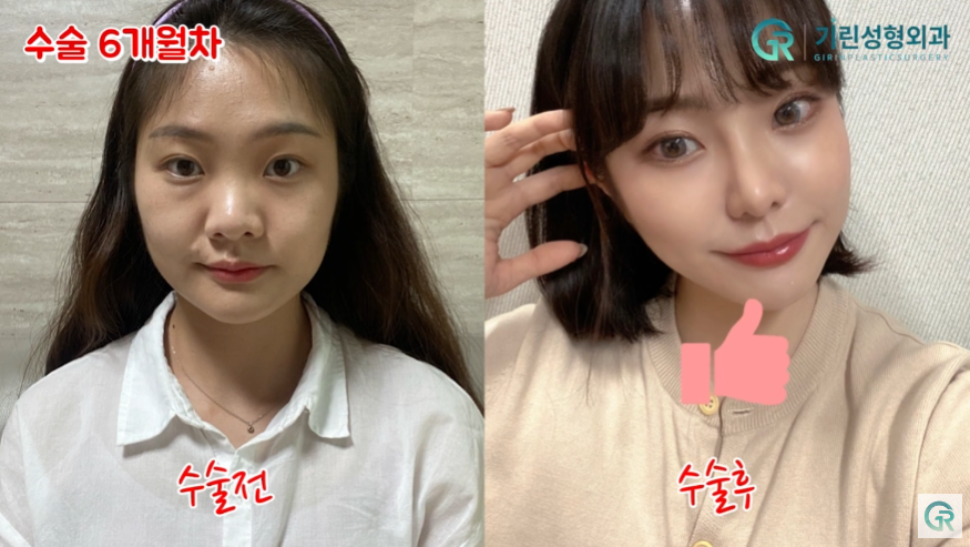 [기린성형외과의원] "카리나가 되고싶어요"_안면윤곽 수술일지 관련 이미지 10
