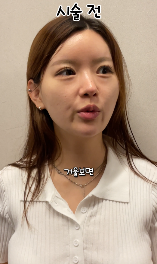 기린성형외과 쥬베룩볼륨 팔자주름, 앞볼, 관자 후기 관련 이미지 2