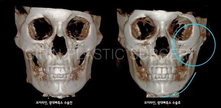 브이라인, 광대고정술 5개월경과 관련 이미지 4