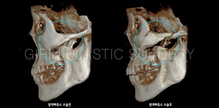 앞광대가 크게 발달한 유형 관련 이미지 5
