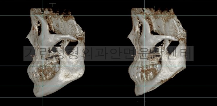 넓은턱수술+아큐스컬프+귀족 1달차 관련 이미지 7