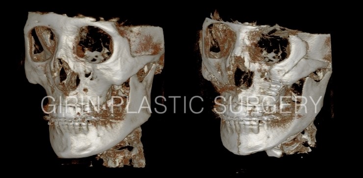 턱길이줄임+브이라인+광대고정술 16일/30일 경과 관련 이미지 6