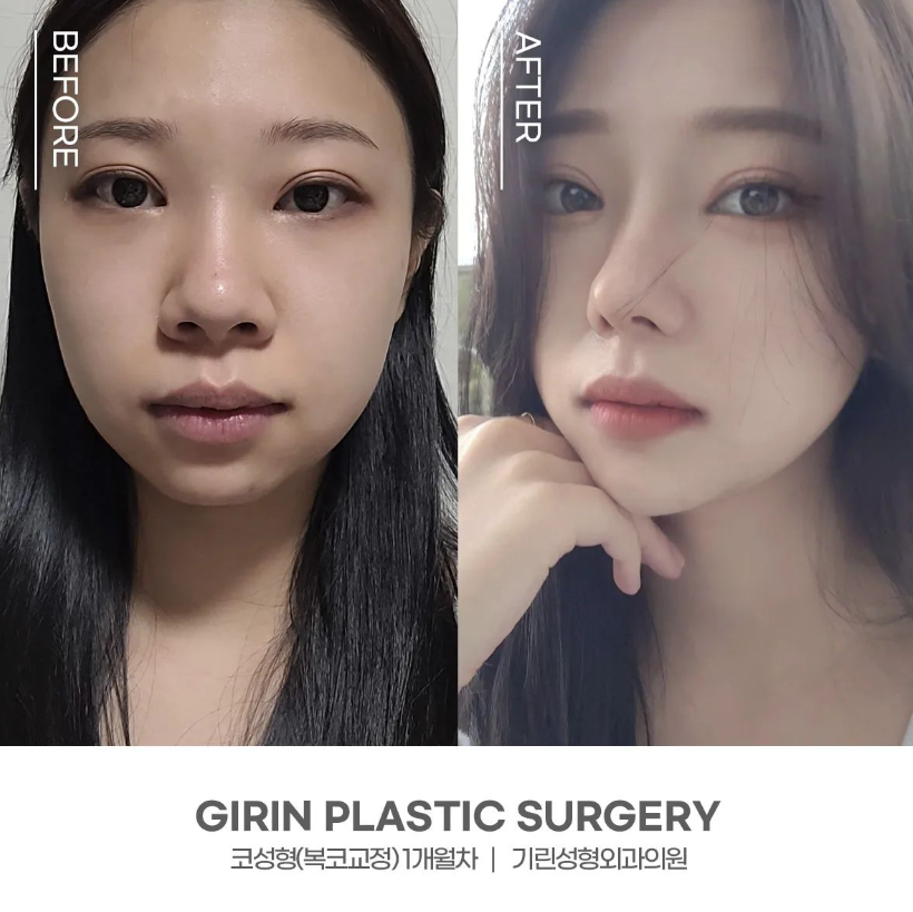 콧볼축소술 뭉툭한 코 개선을 위해 관련 이미지 12