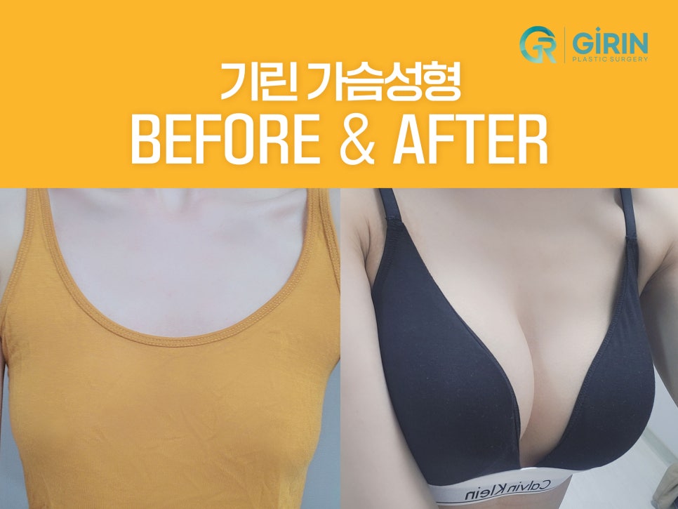 모티바가슴성형후기 세심하게 살펴보며 관련 이미지 1