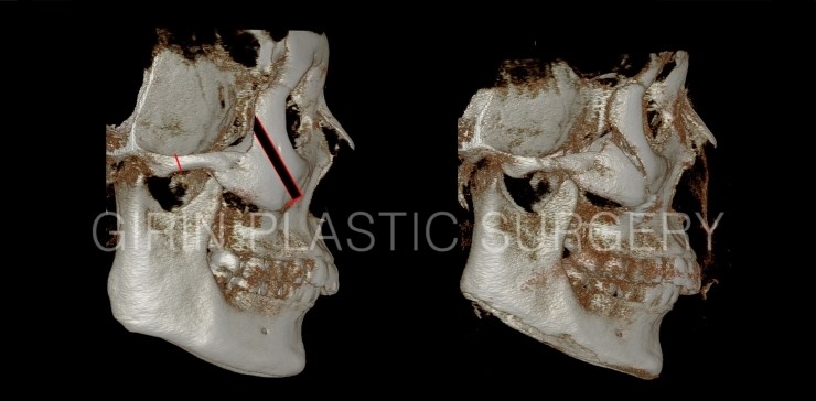 광대축소 불유합과 L절골에 대해 관련 이미지 5