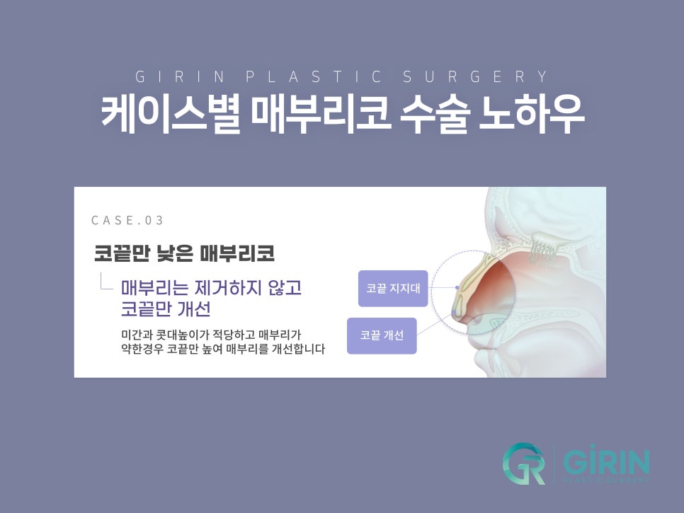매부리코수술후기 방법까지 확인해 관련 이미지 7