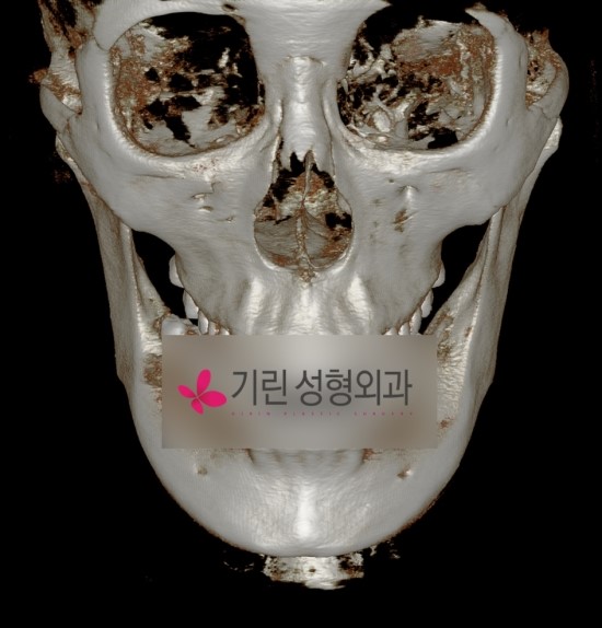앞턱길이축소로 브이라인 효과 (전후CT사진) 관련 이미지 1