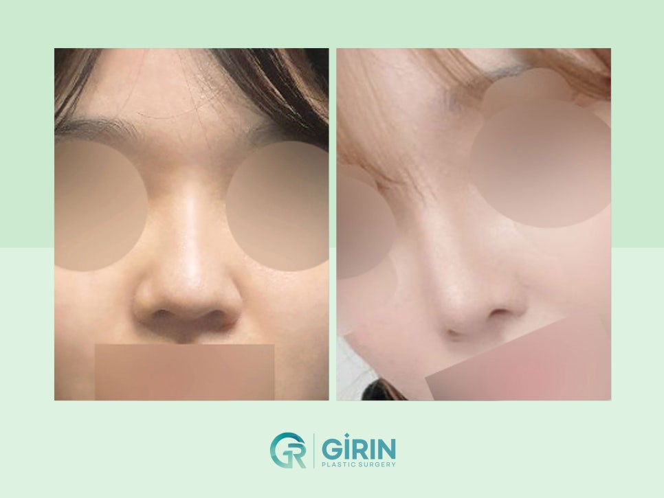 비염코성형 실비 가능성 있기에 관련 이미지 10