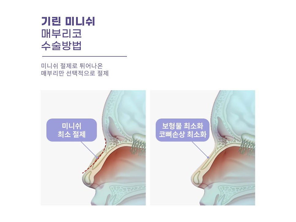 서울코수술 생김새에 따라 다르게 관련 이미지 6