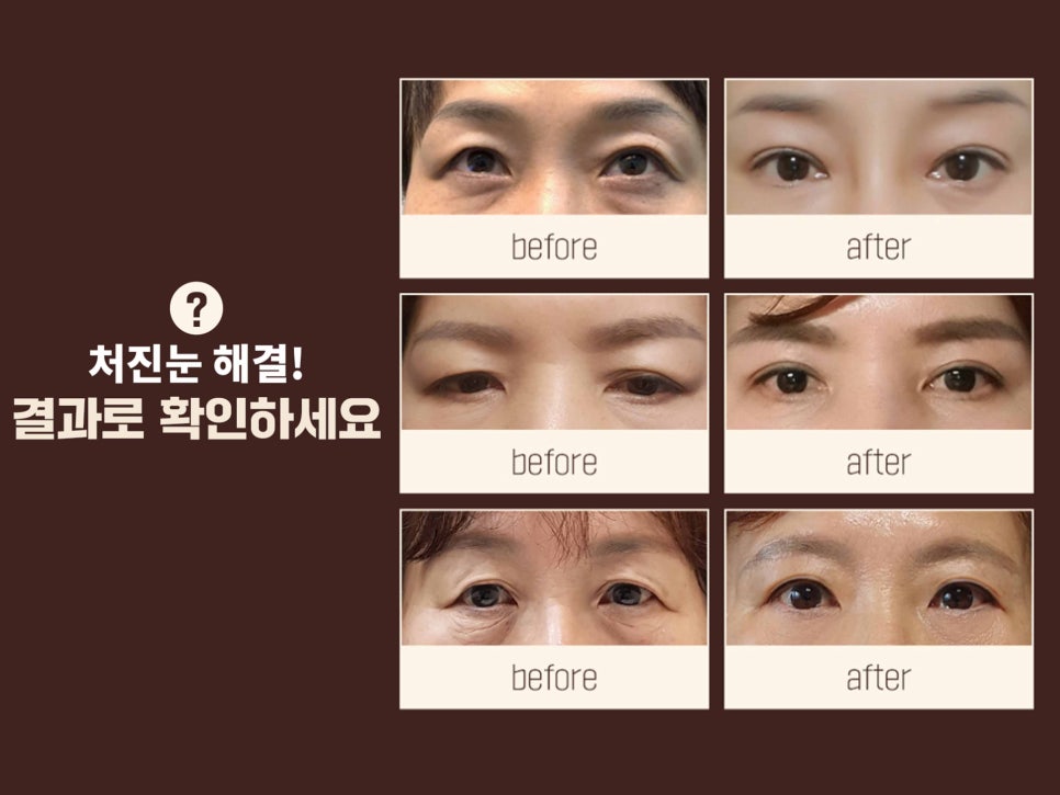 처진눈수술 눈매를 바꾸는 방법 관련 이미지 3