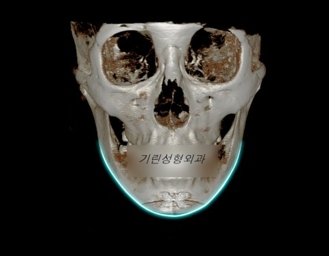 긴턱 사각턱수술 : 앞턱이 긴 경우 관련 이미지 2