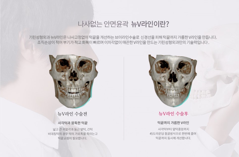 [뉴브이라인] 45도 라운딩 브이라인 절골술로 작은 얼굴 만들기 관련 이미지 3