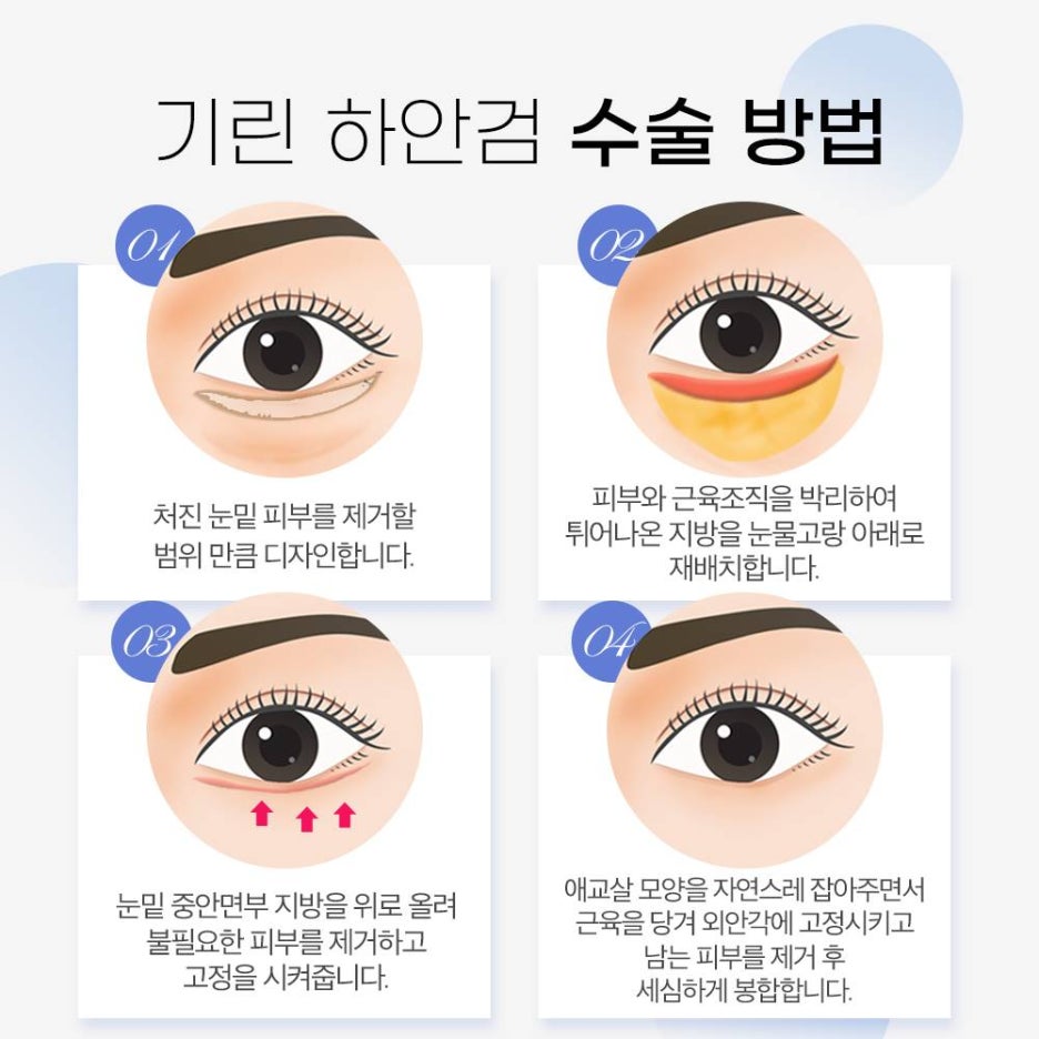 기린성형외과 안티에이징 눈성형 특별한 무엇? 관련 이미지 6