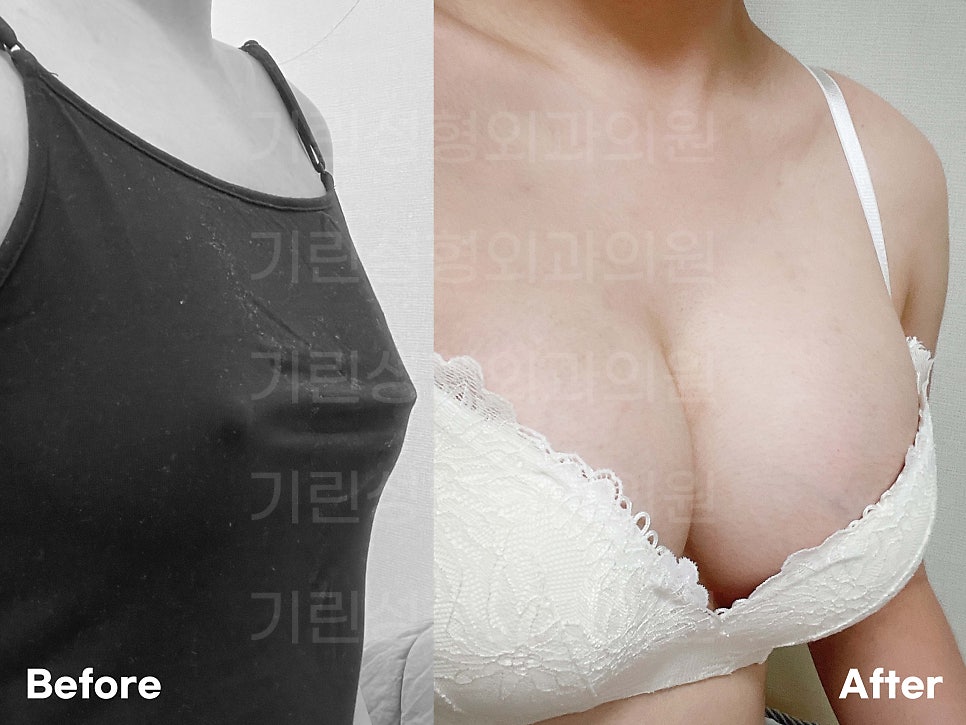 멘토가슴성형 차이를 알고 선택해야 관련 이미지 6