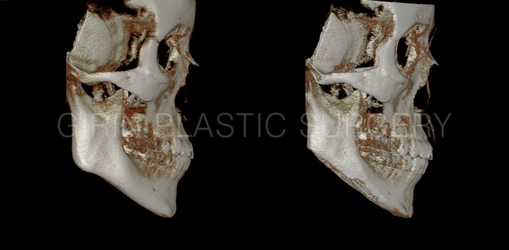긴곡선브이라인 수술후3주 ->4주 경과 관련 이미지 5