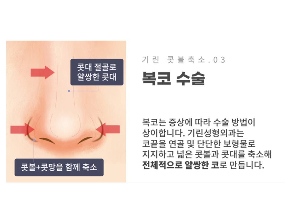 콧볼축소술 세련된 인상을 원한다면 관련 이미지 7