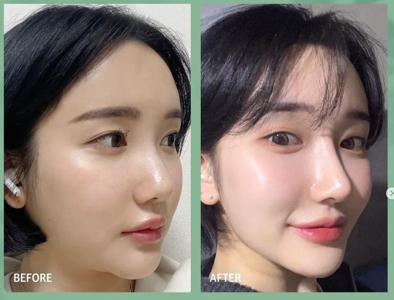 낮은코수술 눈에 보이는 차이를 원한다면 관련 이미지 12