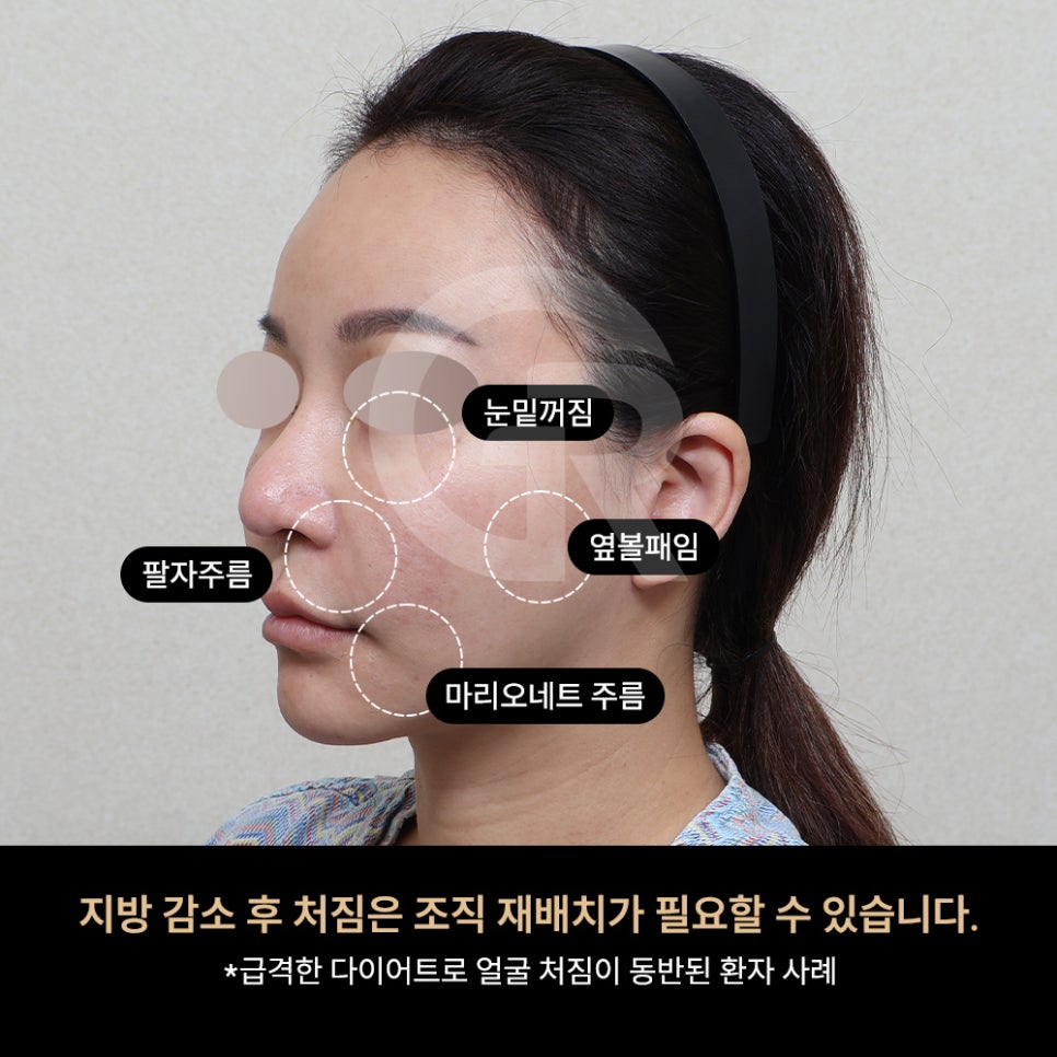 위고비&middot;마운자로 후 얼굴처짐으로 인한 미니거상 후기 관련 이미지 4