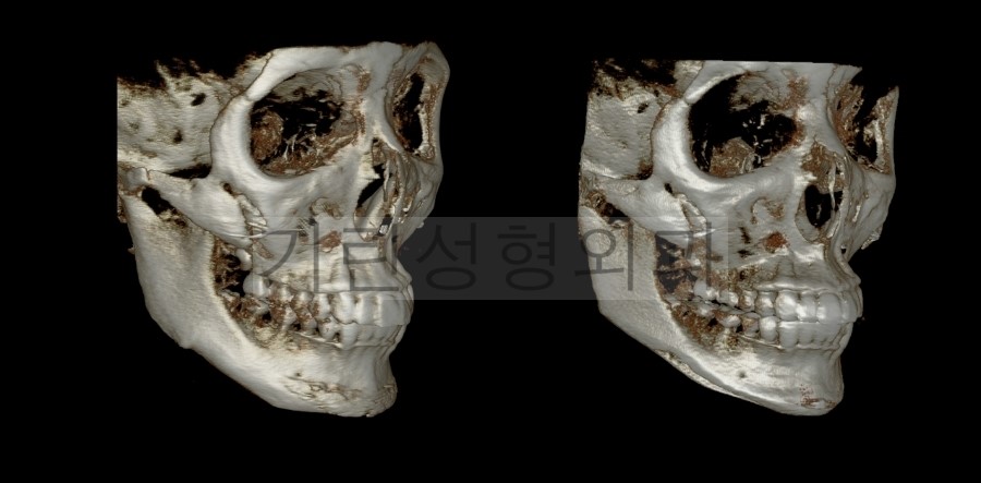 [브이라인재수술사례] 이차각제거 & 광대재수술이 필요없는 이유 관련 이미지 2