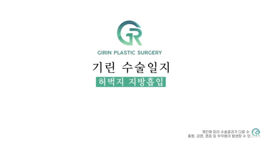 [기린성형외과의원] 뼈벅지?허틈!_허벅지지방흡입 수술일지 관련 이미지 1
