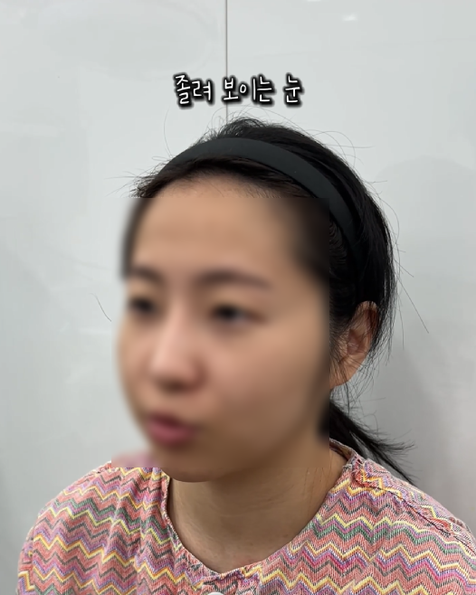 강남역 근처 쌍꺼풀 잘하는 곳 어디? 생생한 후기 관련 이미지 3