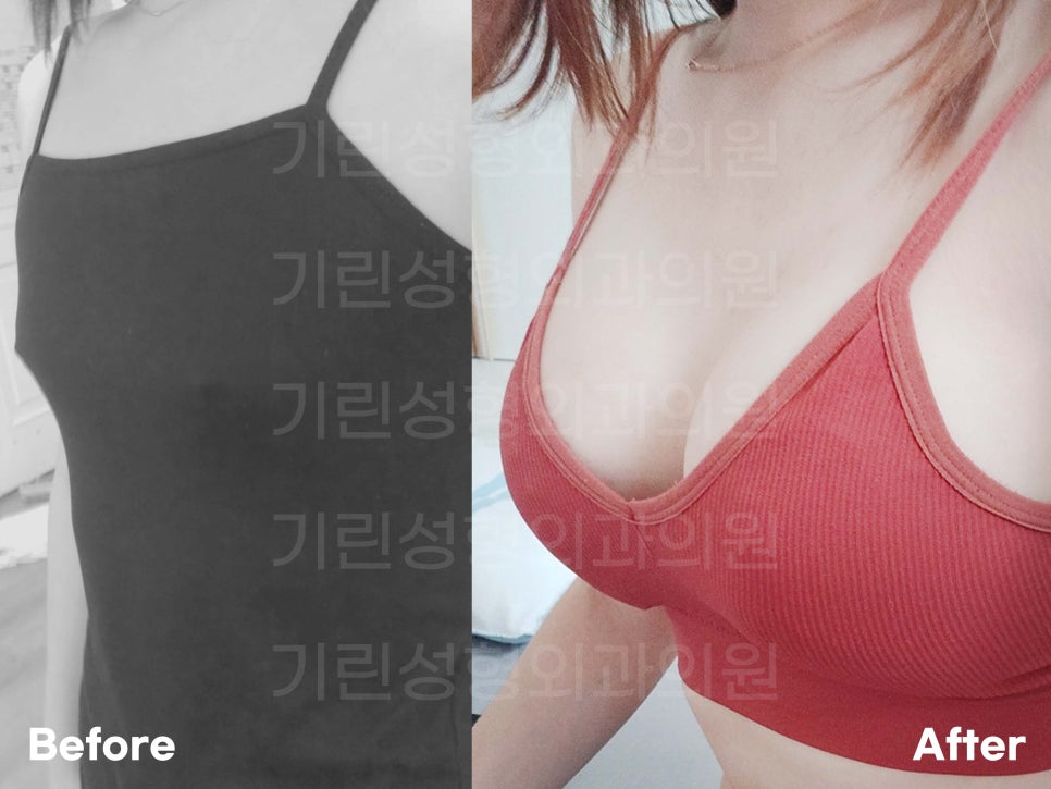 멘토가슴성형 차이를 알고 선택해야 관련 이미지 2