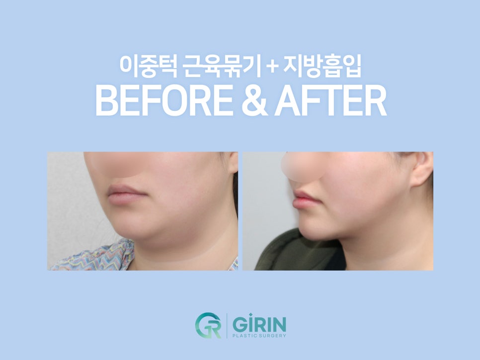 이중턱지방흡입 하나로 어렵다면? 관련 이미지 2