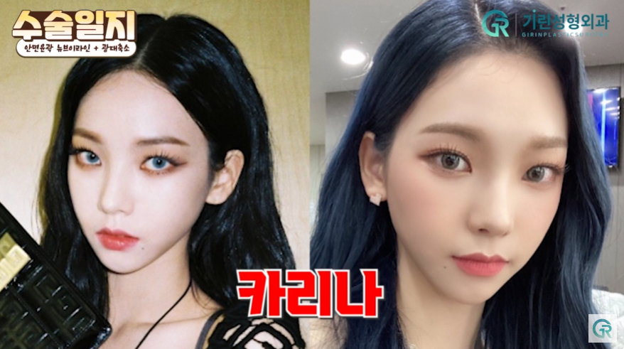 [기린성형외과의원] "카리나가 되고싶어요"_안면윤곽 수술일지 관련 이미지 2