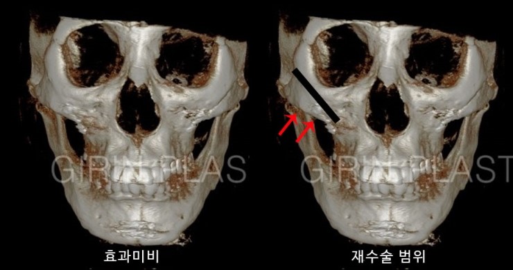 안면윤곽재수술 시 고려해야 할 점 관련 이미지 9