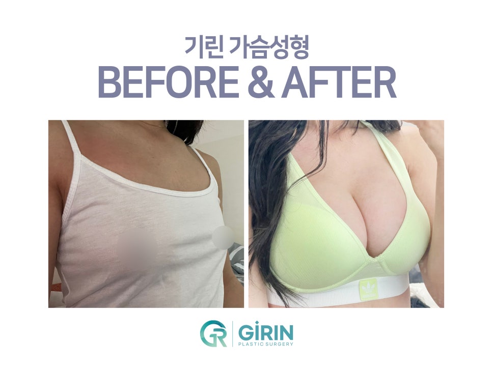 강남가슴성형 달라질 라인 기대하며 관련 이미지 7