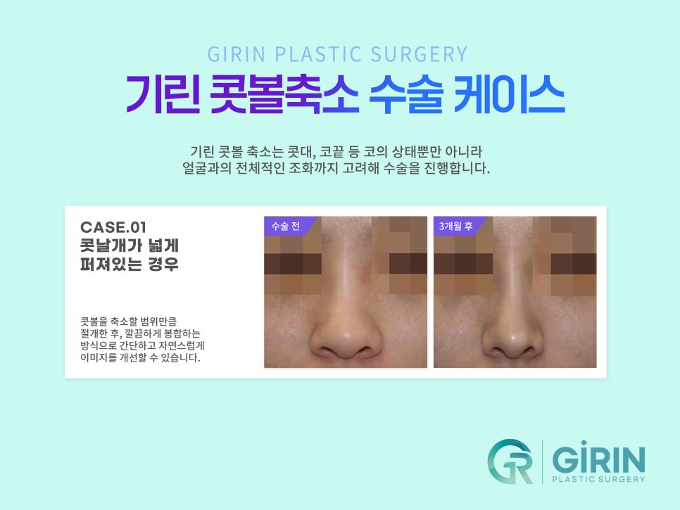 콧볼축소술 뭉툭한 코 개선을 위해 관련 이미지 9