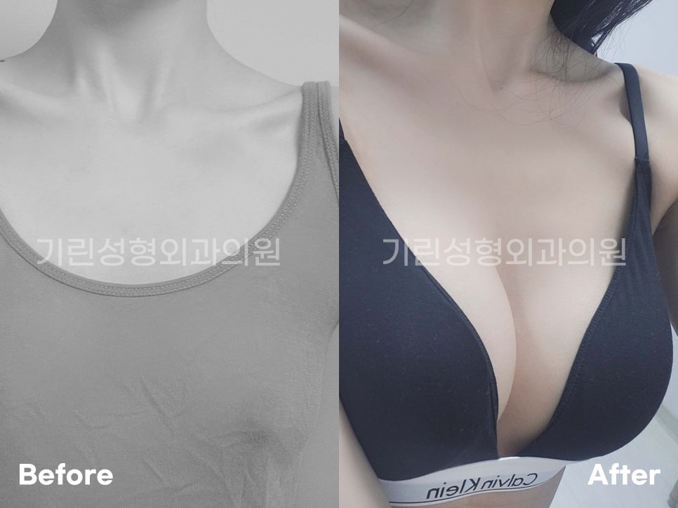 가슴확대수술전후 개선한 모습 궁금하다면 관련 이미지 5