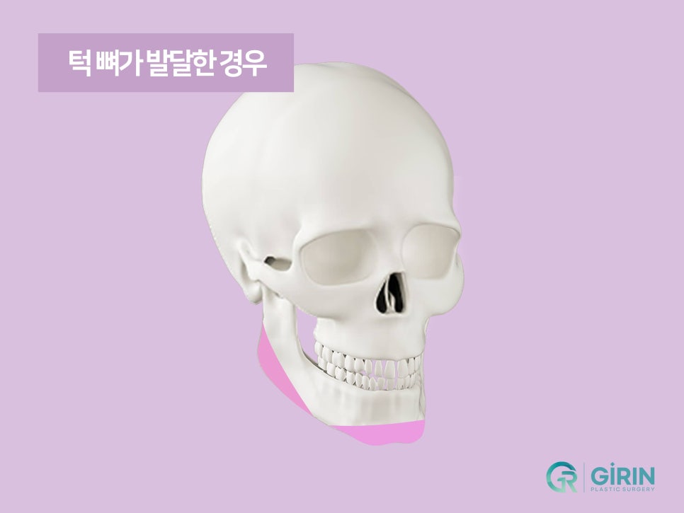 강남이중턱지방흡입 체크할 것 관련 이미지 4