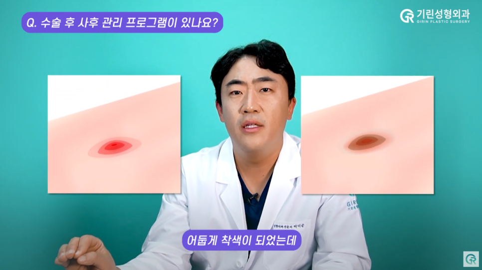 [기린성형외과] "흡연 얼마나 하세요?"_ 지방흡입수술 후 Q&A 관련 이미지 16