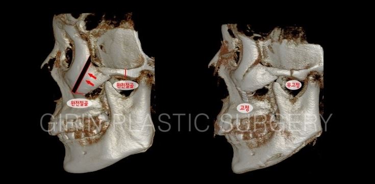 케이스에 맞는 광대뼈축소술 관련 이미지 3