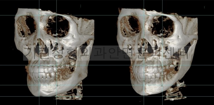 넓은턱수술+아큐스컬프+귀족 1달차 관련 이미지 6