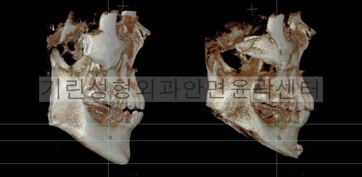 남자긴턱줄임+자가뼈앞턱수술+광대고정 수술다음날CT 관련 이미지 4