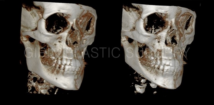 긴곡선브이라인 수술후3주 ->4주 경과 관련 이미지 4