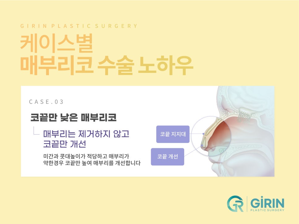 여자코성형 원하는 라인 고려하여 관련 이미지 9