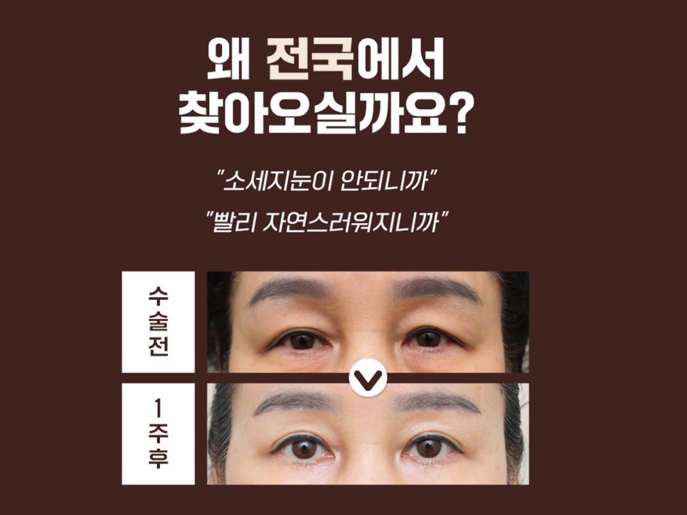 처진눈수술 눈매를 바꾸는 방법 관련 이미지 6
