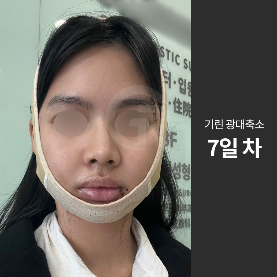 광대가 큰 얼굴, 축소술은 인상을 조율하는 기준점입니다 관련 이미지 2