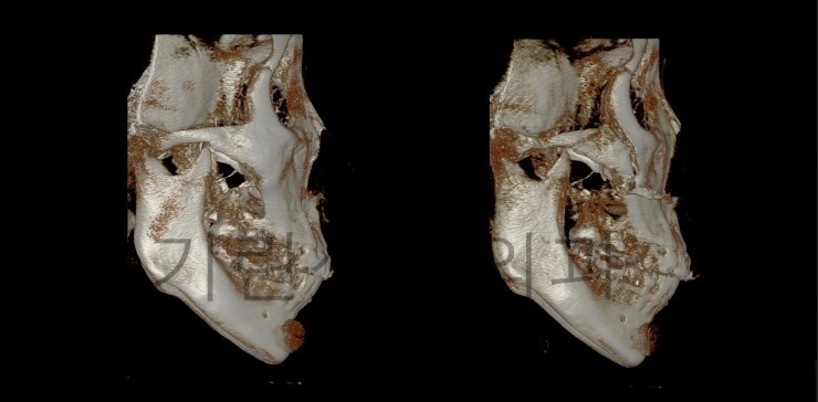 광대뼈고정, 볼처짐 아큐스컬프 사례입니다. 관련 이미지 3