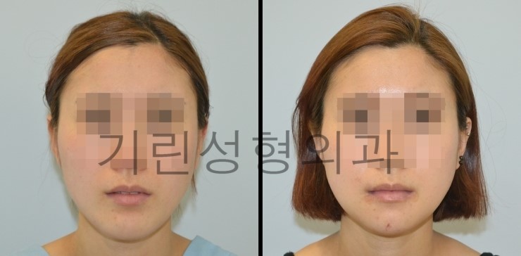 사각턱재수술 길이줄임 7일경과사진 관련 이미지 1