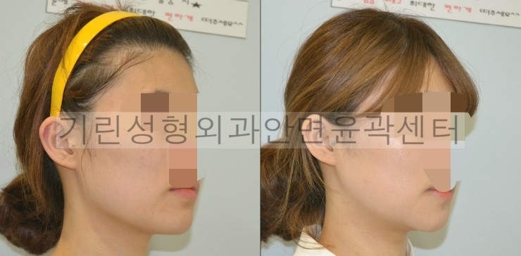 넓은턱수술+아큐스컬프+귀족 1달차 관련 이미지 2