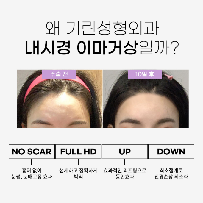 이마거상수술 주름을 개선하는 관련 이미지 12