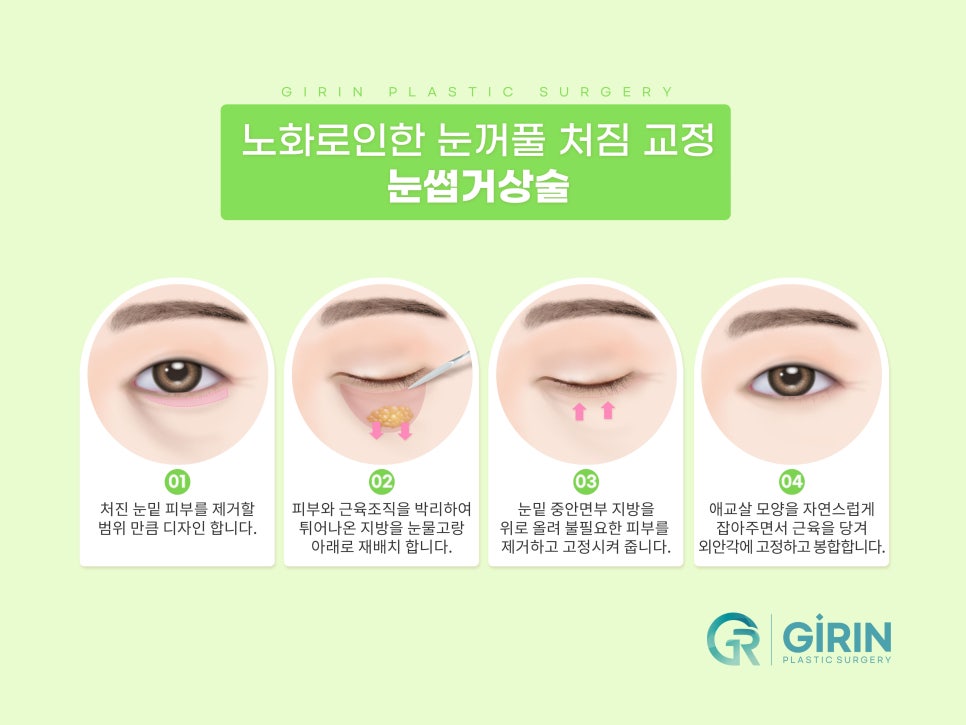 상안검수술잘하는곳 알아본다면 관련 이미지 12