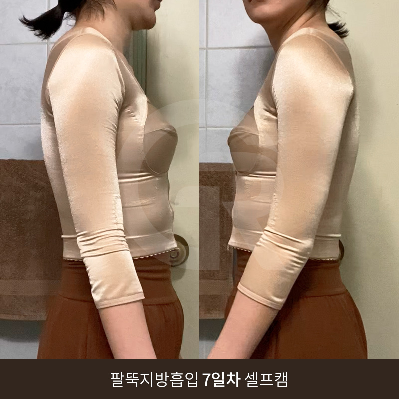 요가로 소용없던 굵은 팔뚝 지방흡입 수술 후기 관련 이미지 9