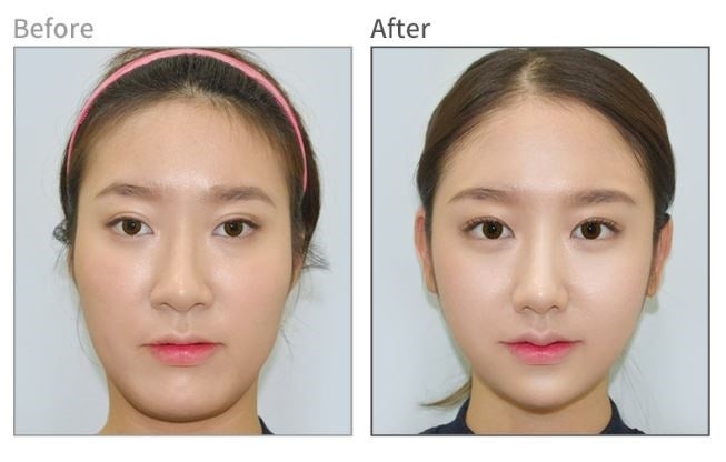 안면윤곽후기? 사실 도움 안 되는 이유 관련 이미지 2