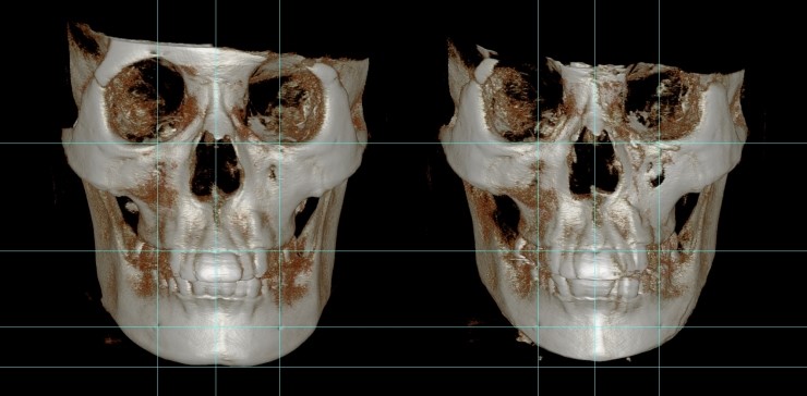 넓은턱 수술사례 관련 이미지 4